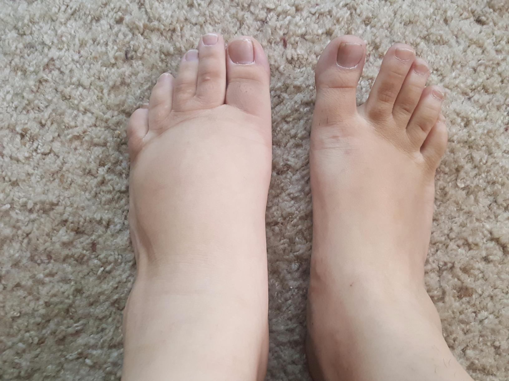 Customer photo shared in a 1 Body Thyroid Support review showing reduced foot swelling after several weeks of use